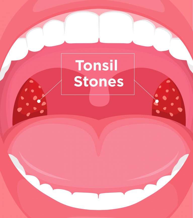 What Are Tonsil Stones Tonsilloliths Symptoms And Treatment Upmc