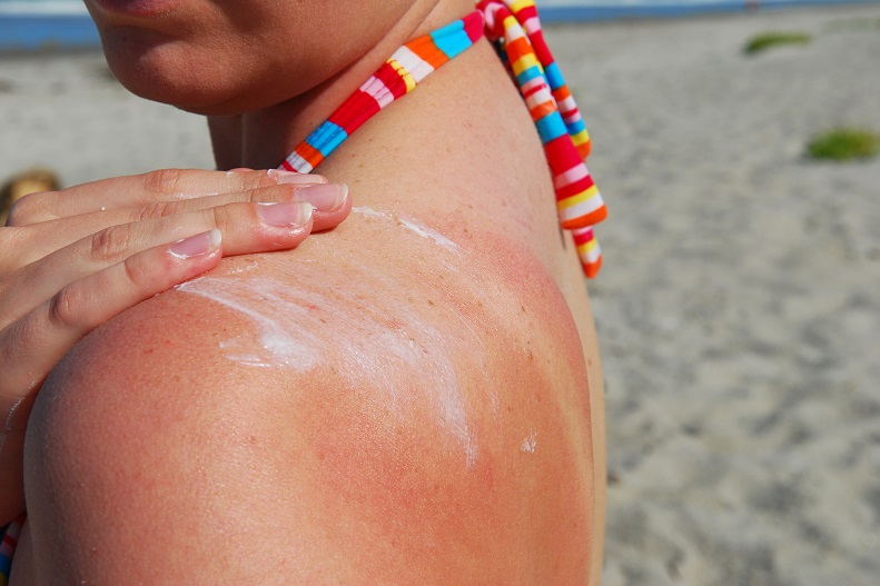 Sunburn Or Sun Poisoning Tell The Difference Upmc
