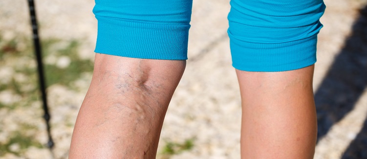 The Best Time for Spider Vein and Varicose Vein Treatment | UPMC