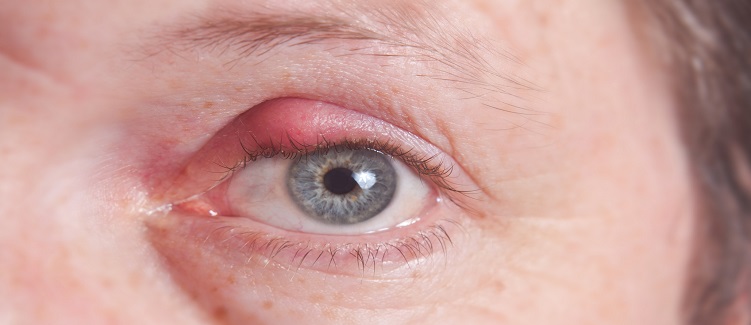 what causes stye on eye